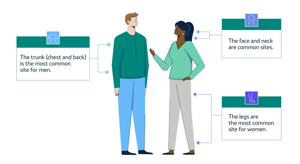 Illustration of a man and woman and the most common locations of melanoma