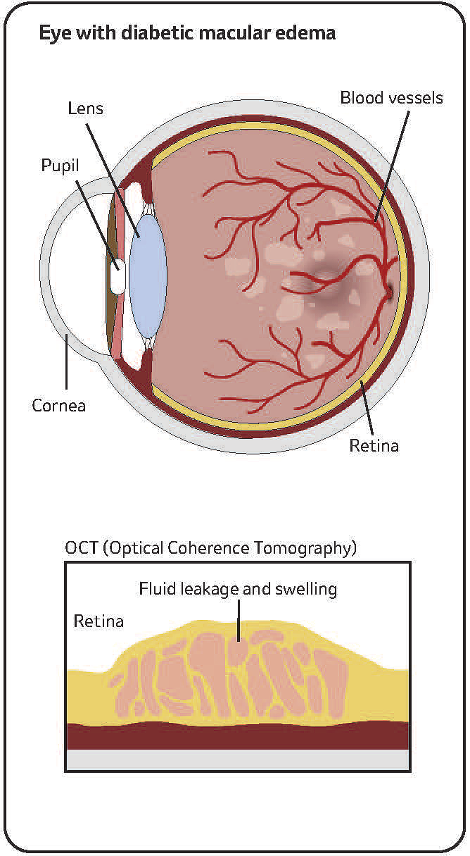 Illustration of eye with DME