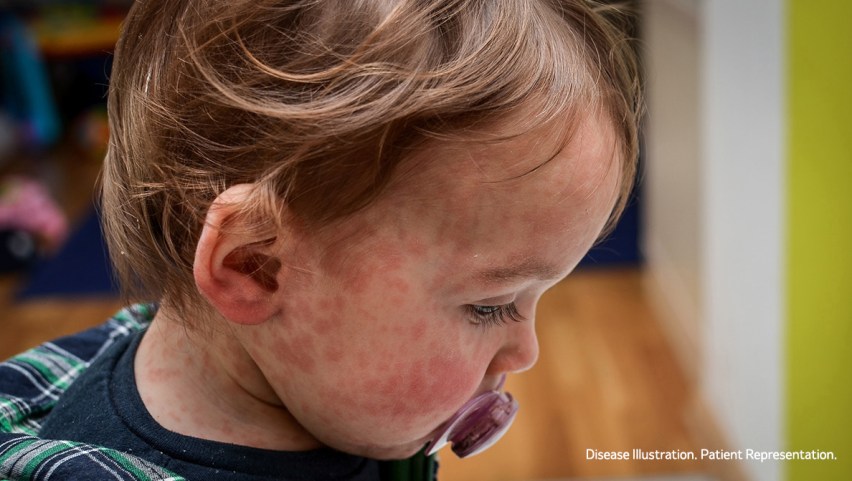 Measles: signs and symptoms